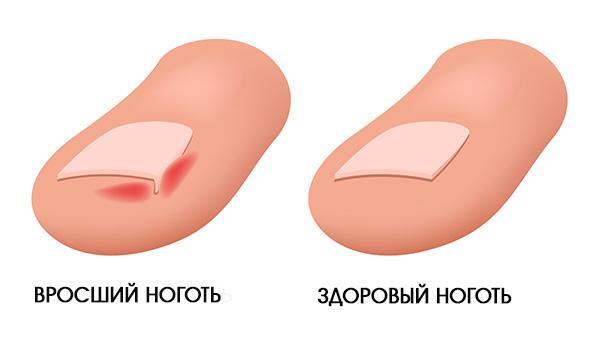 Как снимают ноготь ребенку
